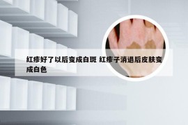 红疹好了以后变成白斑 红疹子消退后皮肤变成白色