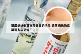 银屑病抹他莫克司软膏的功效 银屑病抹他克莫司多久见效