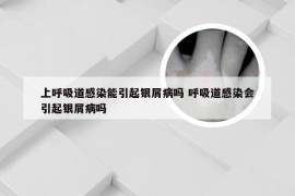 上呼吸道感染能引起银屑病吗 呼吸道感染会引起银屑病吗