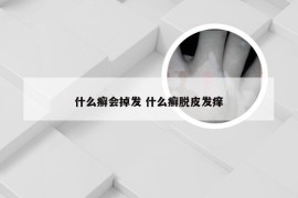 什么癣会掉发 什么癣脱皮发痒