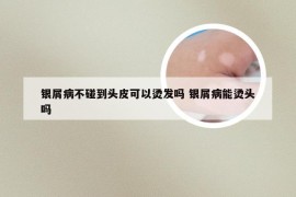 银屑病不碰到头皮可以烫发吗 银屑病能烫头吗