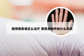 刚得银屑病怎么治疗 银屑病刚开始什么症状