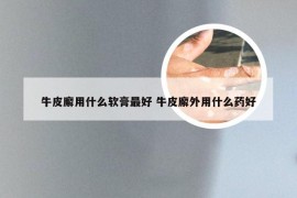 牛皮廨用什么软膏最好 牛皮廨外用什么药好