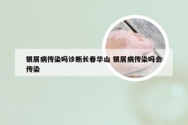 银屑病传染吗诊断长春华山 银屑病传染吗会传染