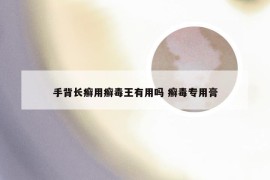 手背长癣用癣毒王有用吗 癣毒专用膏