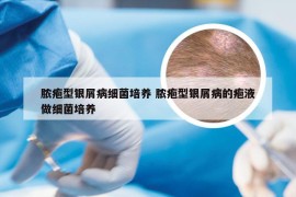 脓疱型银屑病细菌培养 脓疱型银屑病的疱液做细菌培养