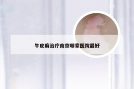 牛皮癣治疗南京哪家医院最好