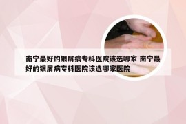 南宁最好的银屑病专科医院该选哪家 南宁最好的银屑病专科医院该选哪家医院