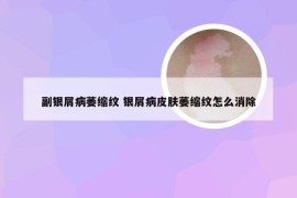 副银屑病萎缩纹 银屑病皮肤萎缩纹怎么消除