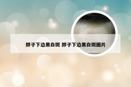 脖子下边黑白斑 脖子下边黑白斑图片