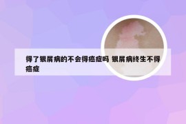 得了银屑病的不会得癌症吗 银屑病终生不得癌症