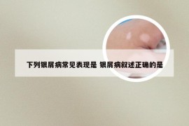 下列银屑病常见表现是 银屑病叙述正确的是