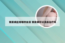 银屑病适用哪种血清 银屑病可以清血治疗吗