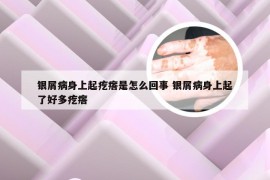 银屑病身上起疙瘩是怎么回事 银屑病身上起了好多疙瘩