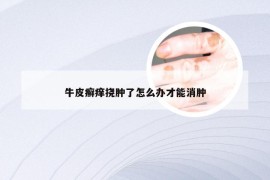 牛皮癣痒挠肿了怎么办才能消肿