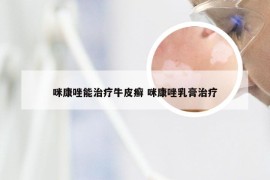 咪康唑能治疗牛皮癣 咪康唑乳膏治疗