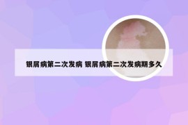 银屑病第二次发病 银屑病第二次发病期多久