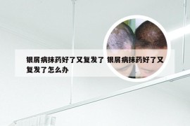 银屑病抹药好了又复发了 银屑病抹药好了又复发了怎么办