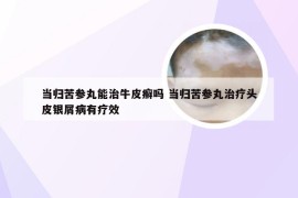 当归苦参丸能治牛皮癣吗 当归苦参丸治疗头皮银屑病有疗效