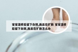 宝宝湿疹后留下白斑,而且在扩散 宝宝湿疹后留下白斑,而且在扩散怎么办