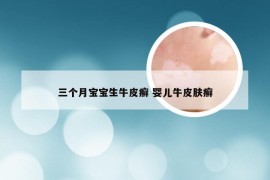 三个月宝宝生牛皮癣 婴儿牛皮肤癣