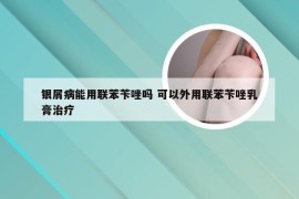 银屑病能用联苯苄唑吗 可以外用联苯苄唑乳膏治疗