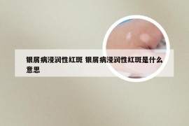 银屑病浸润性红斑 银屑病浸润性红斑是什么意思