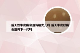 后天性牛皮癣会遗传给女儿吗 后天牛皮肤癣会遗传下一代吗