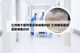 兰州哪个医院看皮肤病看的好 兰州哪家医院皮肤病看的好