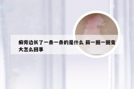 癣旁边长了一条一条的是什么 藓一圈一圈变大怎么回事