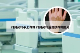 打封闭针手上白斑 打封闭针后皮肤白斑图片