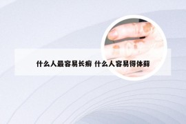 什么人最容易长癣 什么人容易得体藓