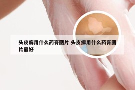 头皮癣用什么药膏图片 头皮癣用什么药膏图片最好