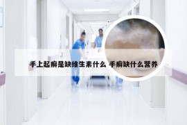 手上起癣是缺维生素什么 手癣缺什么营养