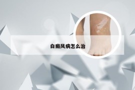 白癜风病怎么治