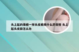 头上起的像癣一样头皮癣用什么药膏擦 头上起头皮藓怎么办