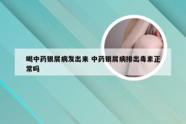 喝中药银屑病发出来 中药银屑病排出毒素正常吗