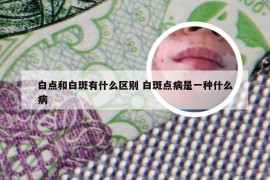 白点和白斑有什么区别 白斑点病是一种什么病