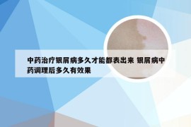 中药治疗银屑病多久才能都表出来 银屑病中药调理后多久有效果