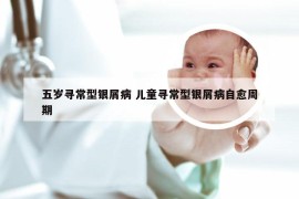 五岁寻常型银屑病 儿童寻常型银屑病自愈周期