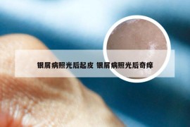 银屑病照光后起皮 银屑病照光后奇痒