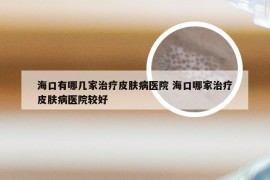 海口有哪几家治疗皮肤病医院 海口哪家治疗皮肤病医院较好