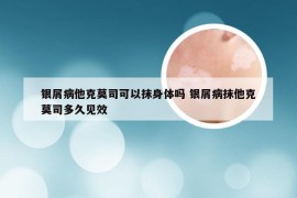 银屑病他克莫司可以抹身体吗 银屑病抹他克莫司多久见效