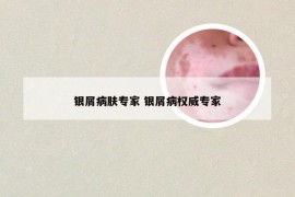 银屑病肤专家 银屑病权威专家