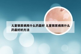 儿童银屑病用什么药最好 儿童银屑病用什么药最好的方法