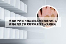 头癣用中药洗了四天后可以用洗发水洗吗 头癣用中药洗了四天后可以用洗发水洗吗图片