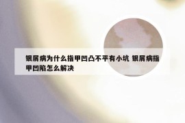 银屑病为什么指甲凹凸不平有小坑 银屑病指甲凹陷怎么解决