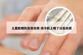 儿童脸晒伤出现白斑 孩子脸上晒了以后白斑