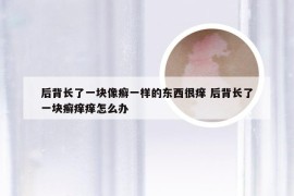 后背长了一块像癣一样的东西很痒 后背长了一块癣痒痒怎么办