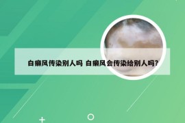 白癞风传染别人吗 白癞风会传染给别人吗?